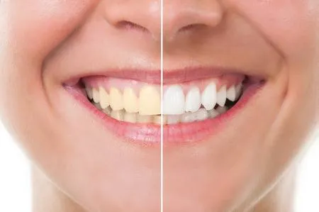 Blanqueamiento dental