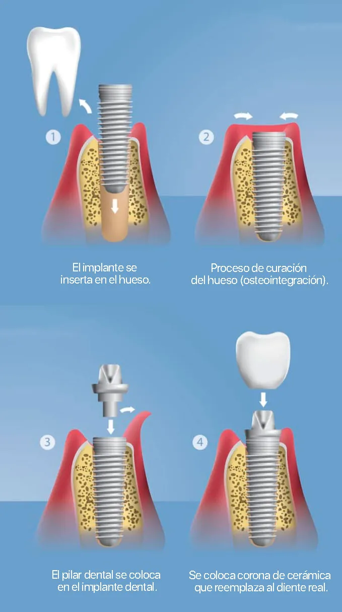 Proceso de colocación de implantes