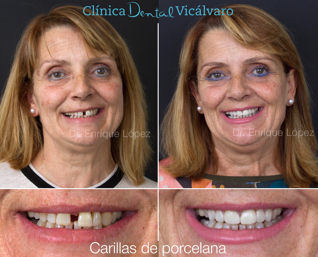 Imagen del caso "carillas de porcelana" Imagen del caso "carillas de porcelana"