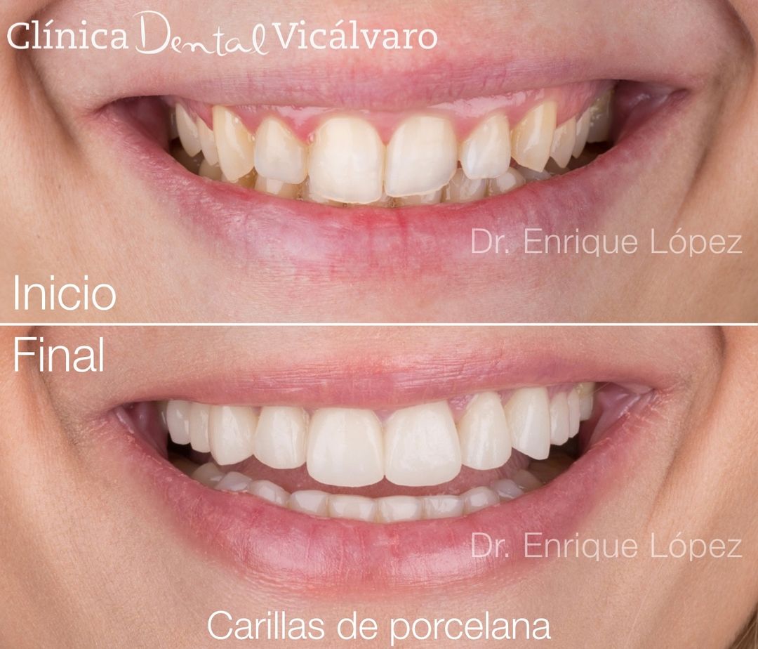 Imagen del caso "carillas de porcelana" Imagen del caso "carillas de porcelana"