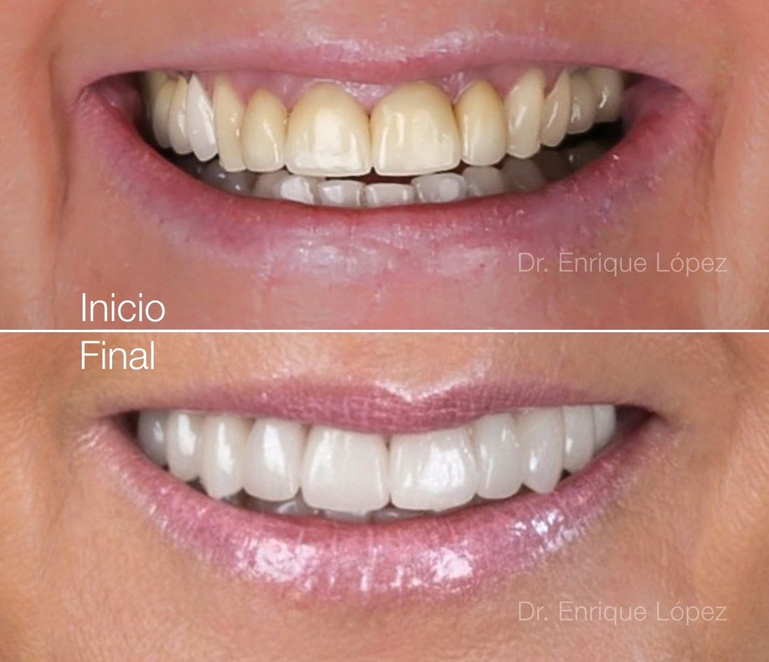 Imagen del caso "carillas de porcelana" Imagen del caso "carillas de porcelana"