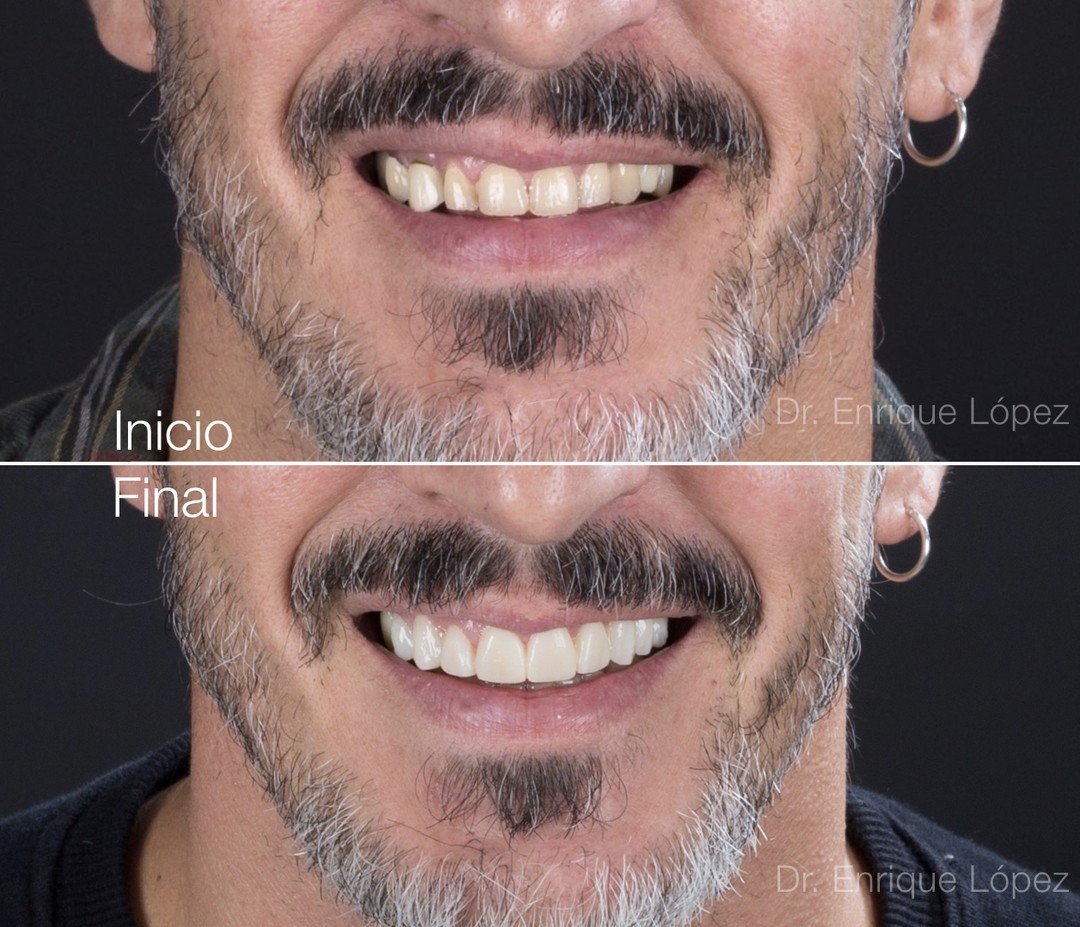 Imagen del caso "carillas de porcelana" Imagen del caso "carillas de porcelana"