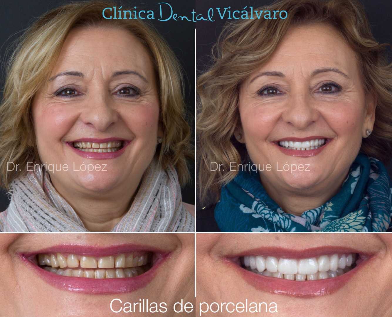 Imagen del caso "carillas de porcelana" Imagen del caso "carillas de porcelana"