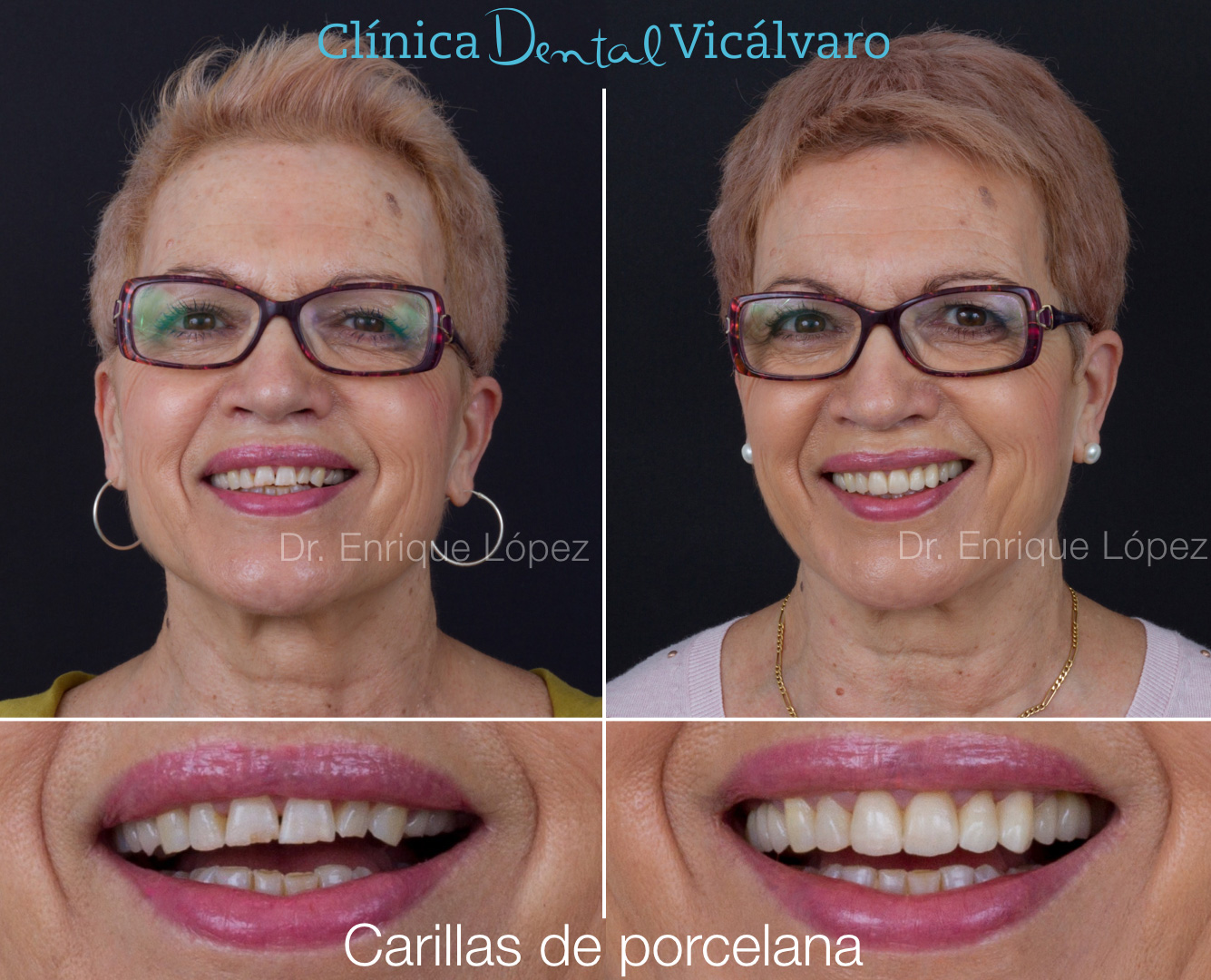 Imagen del caso "carillas de porcelana" Imagen del caso "carillas de porcelana"