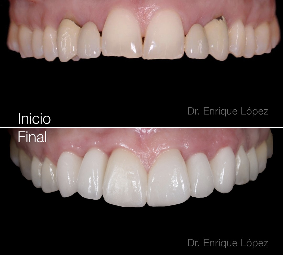 Imagen del caso "ortodoncia, implantes y carillas" Imagen del caso "ortodoncia, implantes y carillas"