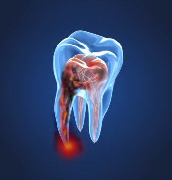 Endodoncia y odontología conservadora