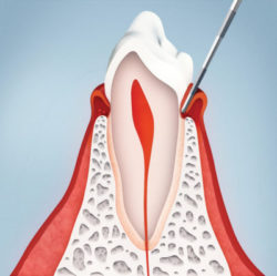 mantenimiento periodontal