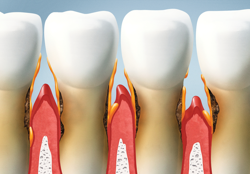 periodontitis moderada